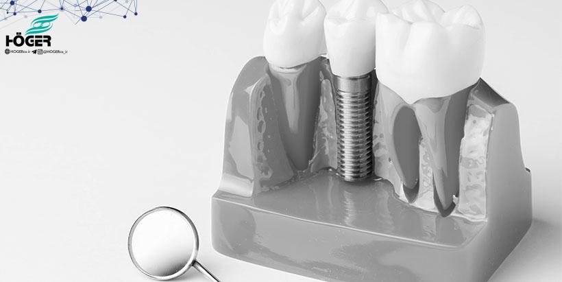 ایمپلنت دندانی 18 Dental equipment