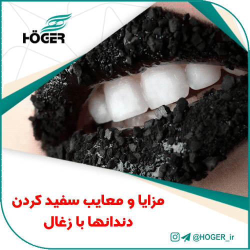 مزایا و معایب سفید کردن دندانها با زغال