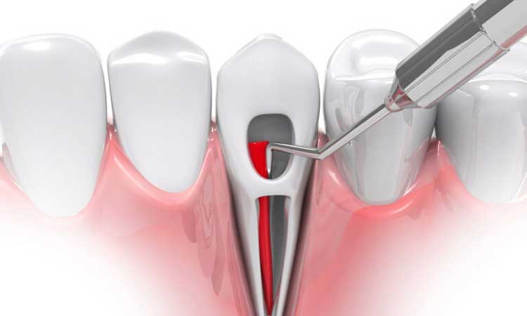 دستگاه اپکس دندانپزشکی