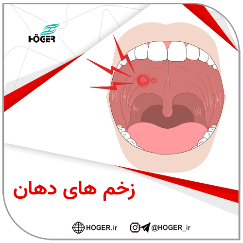 زخم های دهان