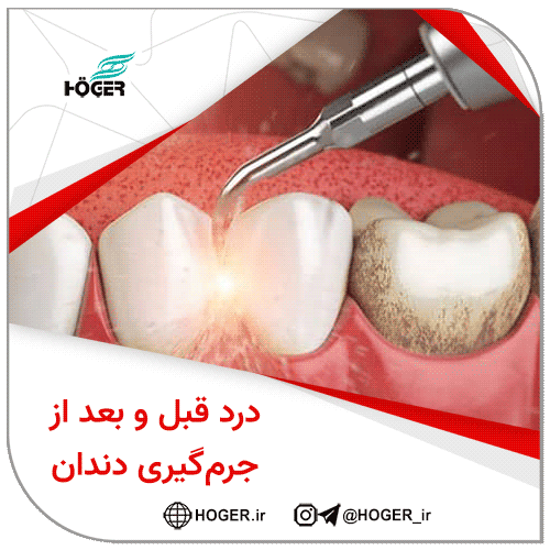 جرم‌گیری دندان