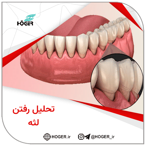 تحلیل رفتن لثه