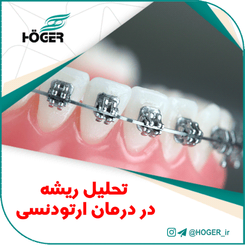 تحلیل ریشه در درمان ارتودنسی