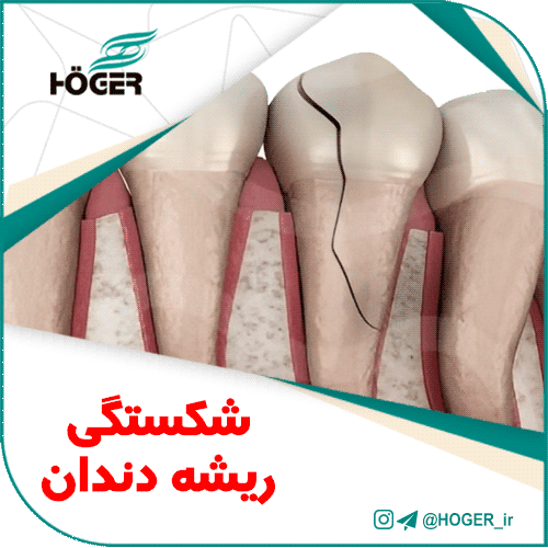 شکستگی ریشه دندان