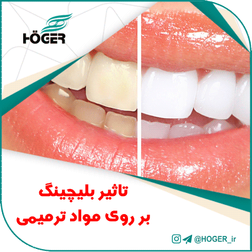 تاثیر بلیچینگ بر روی مواد ترمیمی