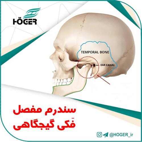 سندرم مفصلی فکی گیجگاهی