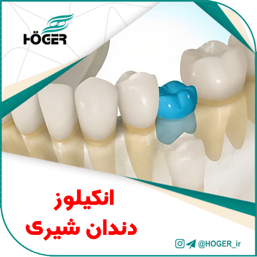 انکیلوز دندان شیری