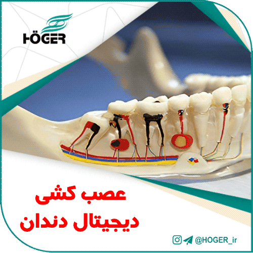 عصب کشی دیجیتال دندان