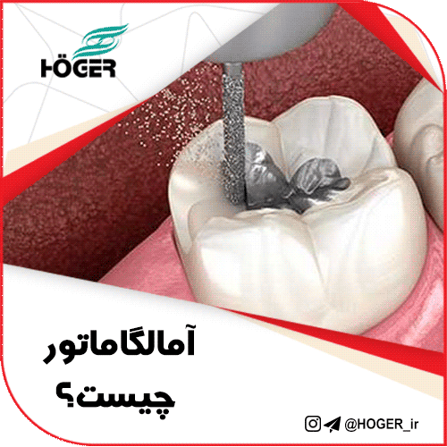 آمالگاماتور چیست؟ 8 آمالگاماتور چیست؟